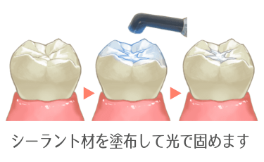 シーラント